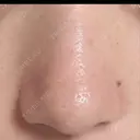 鼻尖形成（切開） / 小鼻縮小（切開） / その他（鼻） 東京形成美容外科 船橋院 DAY 214 サムネイル用