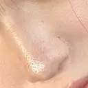 鼻尖形成（切開） / 小鼻縮小（切開） / その他（鼻） 東京形成美容外科 船橋院 DAY 214 サムネイル用