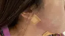 糸リフト / クマ治療 / 脂肪吸引（顔） / 下まぶたたるみ取り / 下まぶたの脂肪取り / 目元修正 / 脂肪吸引注射（顔） / その他（目元） Tokyo Tensei Clinic 新宿院 AFTER サムネイル用
