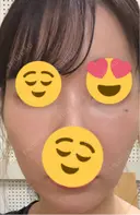 その他（輪郭） ARTE BEAUTY CLINIC DAY 11 サムネイル用
