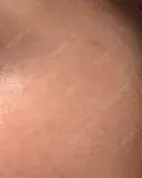 ボトックス（眉間） / ボトックス（目尻） / ボトックス（額） ルラ美容クリニック 広島院 AFTER サムネイル用