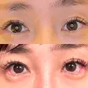 目尻切開 / タレ目形成・グラマラスライン（埋没） LOUIS CLINIC 二子玉川院【ルイクリニック】 DAY 4 サムネイル用