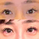 目尻切開 / タレ目形成・グラマラスライン（埋没） LOUIS CLINIC 二子玉川院【ルイクリニック】 DAY 2 サムネイル用
