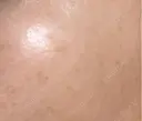 ルメッカ B-LINE CLINIC 池袋院 AFTER サムネイル用