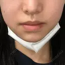 バッカルファット除去 ブルームクリニック（BLOOM CLINIC） DAY 1 サムネイル用
