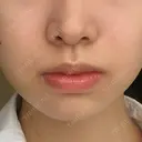 バッカルファット除去 ブルームクリニック（BLOOM CLINIC） AFTER サムネイル用