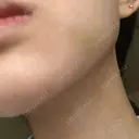 バッカルファット除去 ブルームクリニック（BLOOM CLINIC） DAY 3 サムネイル用