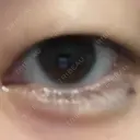 ヒアルロン酸注入（涙袋） 銀座リシェスクリニック DAY 0 サムネイル用