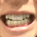 ホワイトニング 緑のテラス歯科クリニック DAY 32 サムネイル用