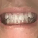 ホワイトニング 緑のテラス歯科クリニック AFTER サムネイル用