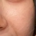 ピーリング（ハリ・ツヤ） リアラクリニック 名古屋院 AFTER サムネイル用