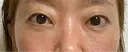 クマ治療 / 下まぶたたるみ取り / 下まぶたの脂肪取り / 脂肪注入（目の下） 湘南美容クリニック 千葉センシティ院 AFTER サムネイル用