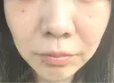 光治療（フォトフェイシャルなど） 大美会クリニック 岡山院 AFTER サムネイル用