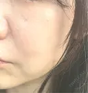 光治療（フォトフェイシャルなど） 大美会クリニック 岡山院 DAY 52 サムネイル用