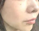 光治療（フォトフェイシャルなど） 大美会クリニック 岡山院 DAY 52 サムネイル用