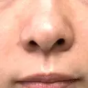 ヒアルロン酸注入（鼻翼基部） おおたかの森ビューティークリニック DAY 1 サムネイル用
