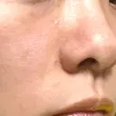 ヒアルロン酸注入（鼻翼基部） おおたかの森ビューティークリニック DAY 3 サムネイル用