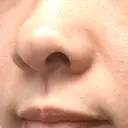 ヒアルロン酸注入（鼻翼基部） おおたかの森ビューティークリニック DAY 7 サムネイル用
