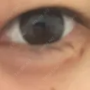 ヒアルロン酸注入（涙袋） 銀座リシェスクリニック DAY 3 サムネイル用