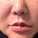 脂肪溶解注射（顔） WellnessPlus Clinic 【ウェルネスプラスクリニック】 DAY 10 サムネイル用