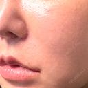 脂肪溶解注射（顔） WellnessPlus Clinic 【ウェルネスプラスクリニック】 DAY 10 サムネイル用