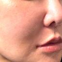脂肪溶解注射（顔） WellnessPlus Clinic 【ウェルネスプラスクリニック】 DAY 10 サムネイル用