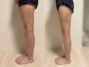 脂肪吸引（脚） 東京脂肪吸引クリニック DAY 61 サムネイル用