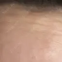 ボトックス（額） / その他（鼻） TCB東京中央美容外科 盛岡院 AFTER サムネイル用