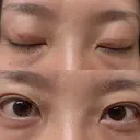 二重埋没 湘南美容クリニック 西葛西院 DAY 1 サムネイル用