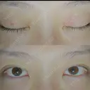 二重埋没 湘南美容クリニック 西葛西院 DAY 2 サムネイル用