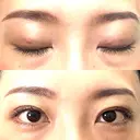 二重埋没 湘南美容クリニック 西葛西院 DAY 2 サムネイル用