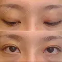 二重埋没 湘南美容クリニック 西葛西院 DAY 3 サムネイル用