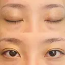 二重埋没 湘南美容クリニック 西葛西院 DAY 5 サムネイル用