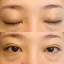 二重埋没 湘南美容クリニック 西葛西院 DAY 7 サムネイル用