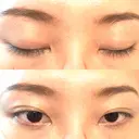 二重埋没 湘南美容クリニック 西葛西院 DAY 28 サムネイル用