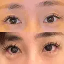 目尻切開 / タレ目形成・グラマラスライン（埋没） LOUIS CLINIC 二子玉川院【ルイクリニック】 DAY 8 サムネイル用