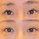 目尻切開 / タレ目形成・グラマラスライン（埋没） LOUIS CLINIC 二子玉川院【ルイクリニック】 DAY 9 サムネイル用