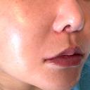 脂肪溶解注射（顔） WellnessPlus Clinic 【ウェルネスプラスクリニック】 DAY 11 サムネイル用