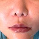 脂肪溶解注射（顔） WellnessPlus Clinic 【ウェルネスプラスクリニック】 DAY 11 サムネイル用
