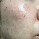 シミ取りレーザー / エレクトロポレーション / 毛穴洗浄（ハイドラフェイシャルなど） まゆりなclinic 名古屋栄 AFTER サムネイル用