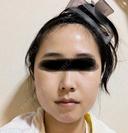 骨切り（あご） / 骨削り（エラ） / 骨削り（頬） セギム美容整形外科 DAY 14 サムネイル用