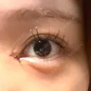 目頭切開 9BeautyClinic DAY 2 サムネイル用