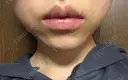ヒアルロン酸注入（唇） / ボトックス（口角） TCB東京中央美容外科 堺院 DAY 4 サムネイル用