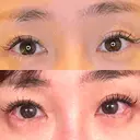 目尻切開 / タレ目形成・グラマラスライン（埋没） LOUIS CLINIC 二子玉川院【ルイクリニック】 DAY 11 サムネイル用