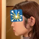 ジョールファット除去 / 脂肪吸引注射（顔） 湘南美容クリニック 大阪梅田本院 DAY 5 サムネイル用