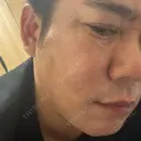 脂肪吸引注射（顔） / ボトックス（エラ・小顔） / その他（肌） LOUIS CLINIC 二子玉川院【ルイクリニック】 DAY 3 サムネイル用