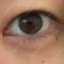 ヒアルロン酸注入（涙袋） 銀座リシェスクリニック AFTER サムネイル用