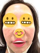 水光注射（ハリ・美肌） / その他（肌） オラクル美容皮膚科 東京新宿院 DAY 0 サムネイル用