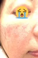 水光注射（ハリ・美肌） / その他（肌） オラクル美容皮膚科 東京新宿院 DAY 0 サムネイル用