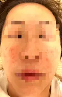 水光注射（ハリ・美肌） / その他（肌） オラクル美容皮膚科 東京新宿院 DAY 1 サムネイル用